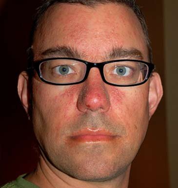 heat rash on baby face. newborn heat rash on face. heat rashes on face. heat,one