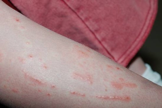 stages of poison ivy rash pictures. mild poison ivy rash pictures.